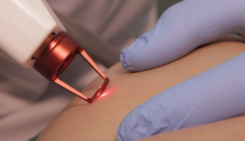 Laser para veias e vasinhos da face, colo e mama